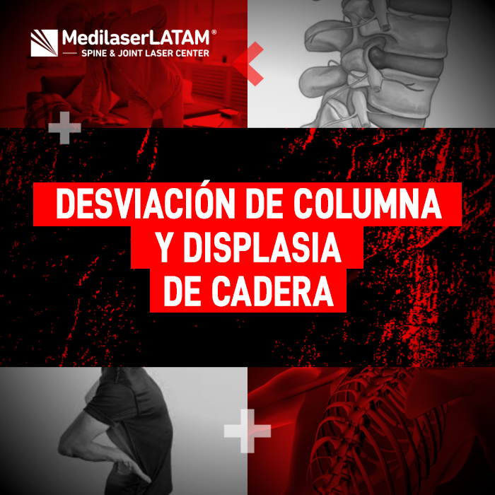 Desviación columna cadera: ¿Cómo se relacionan? El Dr. Rojas explica la conexión entre ambas condiciones y cómo tratarlas con láser.