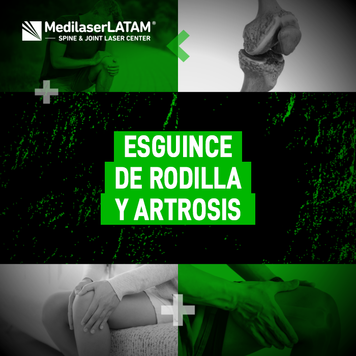 Esguince rodilla artrosis: El Dr. Rojas explica la conexión entre un esguince mal tratado y el deterioro articular. Descubre cómo la cirugía láser lo detiene.