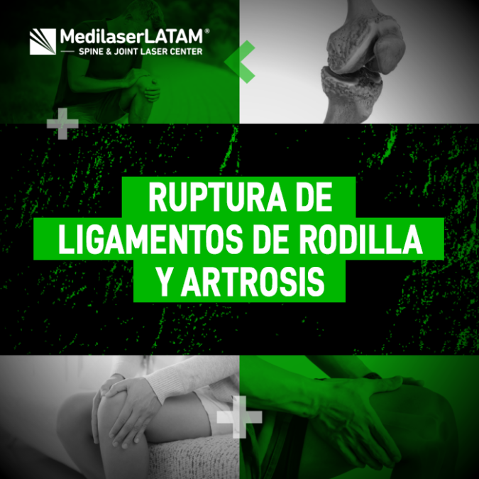 Ruptura ligamentos artrosis: Un ligamento roto genera inestabilidad que termina en artrosis. El Dr. Rojas explica cómo la cirugía láser lo previene.