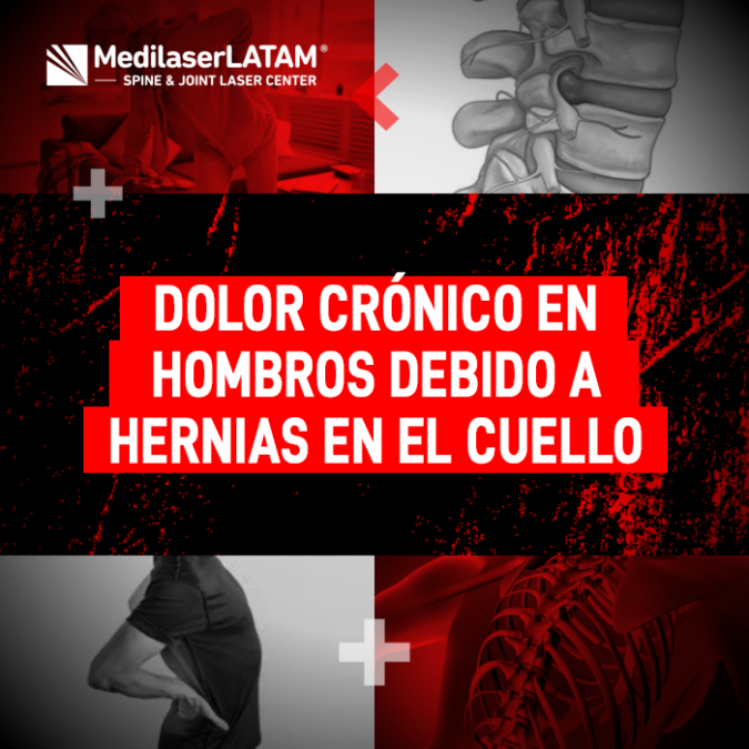 Dolor hombros cuello: El dolor crónico de hombros puede ser una hernia cervical. El Dr. Rojas explica la conexión nerviosa y cómo la cirugía láser la trata.