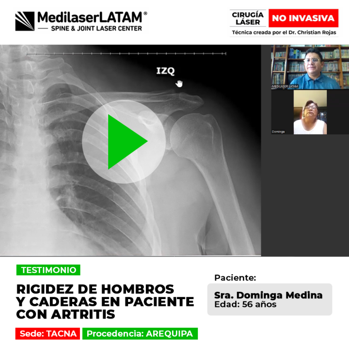 Testimonio: Rigidez Hombros Caderas por artritis en Dominga Medina (56). Vea cómo la cirugía láser frena el deterioro y recupera la movilidad articular.