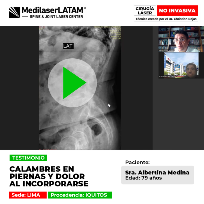 Testimonio: Calambres Dolor Piernas al levantarse en Albertina Medina (79). La cirugía láser alivió el dolor en su columna, eliminando los calambres.