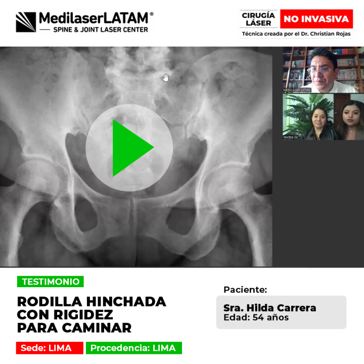 Testimonio: Rodilla Hinchada Rigidez en Hilda Carrera (54). La cirugía láser frenó el deterioro y le devolvió la movilidad sin cirugía mayor.