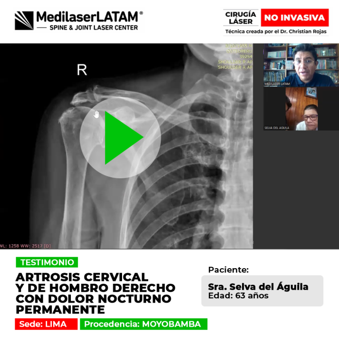 Artrosis cervical y de hombro derecho﻿: Testimonio de la Sra. Selva Del Aguila sobre dolor nocturno en Medilaser LATAM.