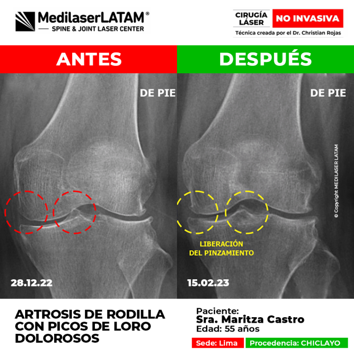 Regresión de gonartrosis izquierda en Ritza Castro documentada con imagenología. La Cirugía Láser como solución NO INVASIVA