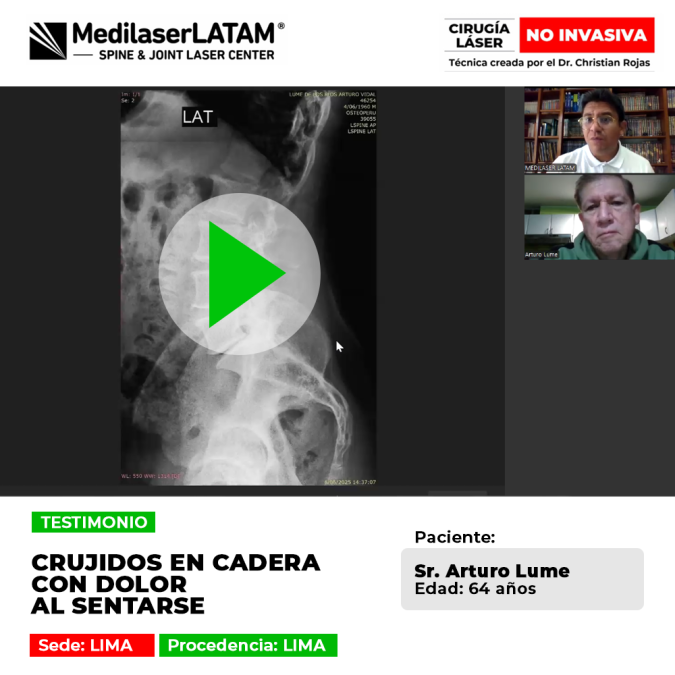 Médico radiólogo supera artrosis severa de cadera. Recuperó su espacio articular y eliminó el dolor al caminar sin cirugías abiertas.Médico radiólogo supera artrosis severa de cadera. Recuperó su espacio articular y eliminó el dolor al caminar sin cirugías abiertas.