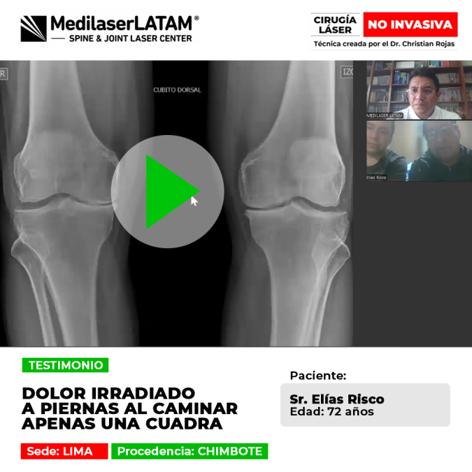 Paciente recuperado de dolor lumbar y rodillas en Lima. Caminaba solo una cuadra y hoy vive sin dolor gracias al láser. ¡Evitó las prótesis!