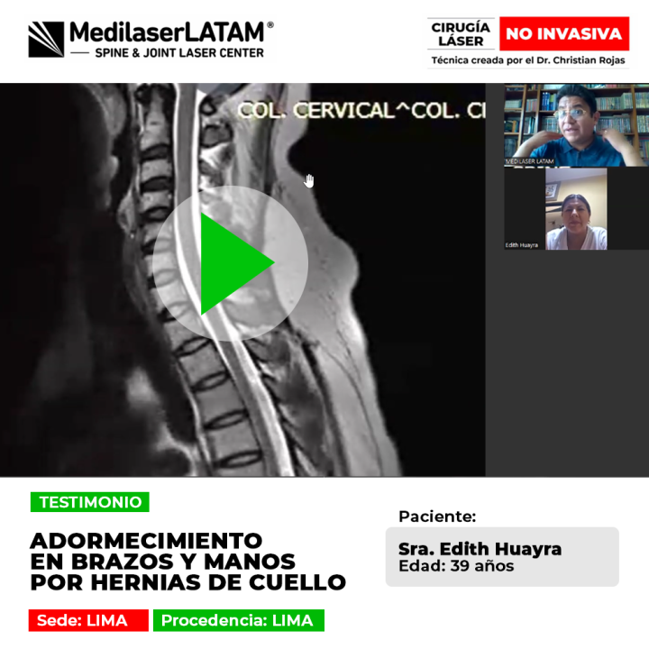 Adiós al adormecimiento de brazos y manos por hernias de cuello. Recupera el sueño y la movilidad con nuestra cirugía láser no invasiva en Perú.