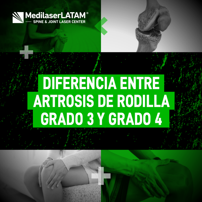 Diferencia entre artrosis grado 3 y 4. Entiende por qué el dolor no siempre coincide con la radiografía y cómo evitar la prótesis con tecnología láser.