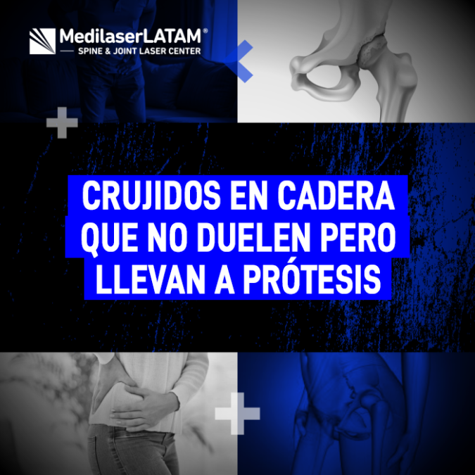 Crujidos en cadera que indican desgaste prematuro. Actúe antes de que el daño sea irreversible y necesite una prótesis de reemplazo.