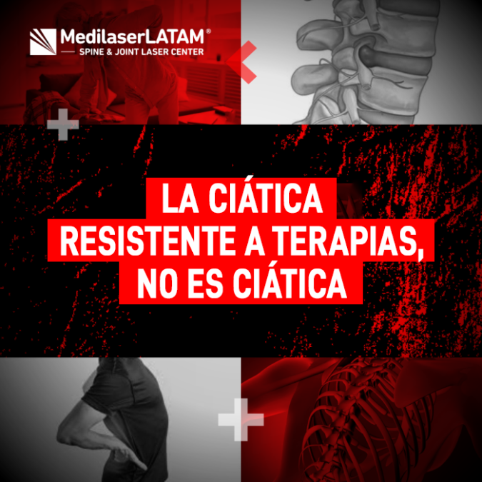 La ciática resistente a terapias no es ciática. Conozca la verdadera causa de su dolor cuando nada parece funcionar.