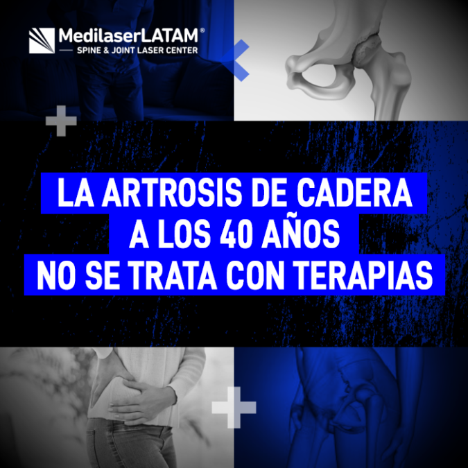 Artrosis de cadera en adultos jóvenes. Descubra por qué las terapias físicas no bastan para frenar el desgaste prematuro de la articulación.