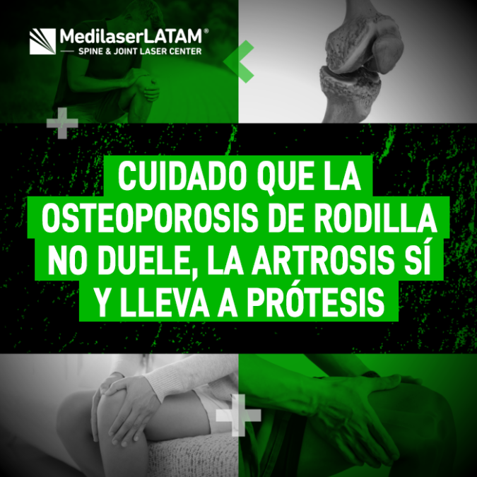 La Osteoporosis de rodilla no duele, la Artrosis sí. Evite la prótesis tratando el desgaste que causa su dolor real.