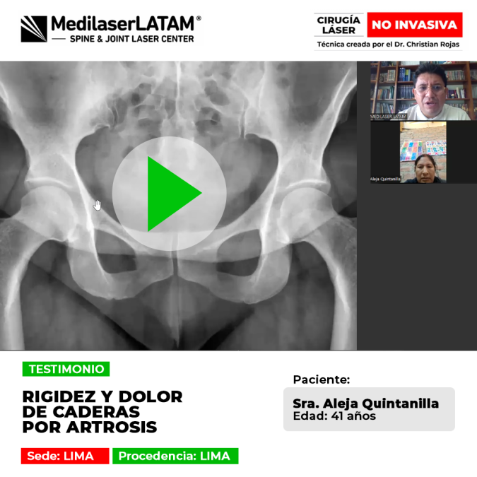 Rigidez y dolor de caderas por artrosis. Descubre una solución efectiva y sin cirugía para recuperar la movilidad con nuestra tecnología láser.