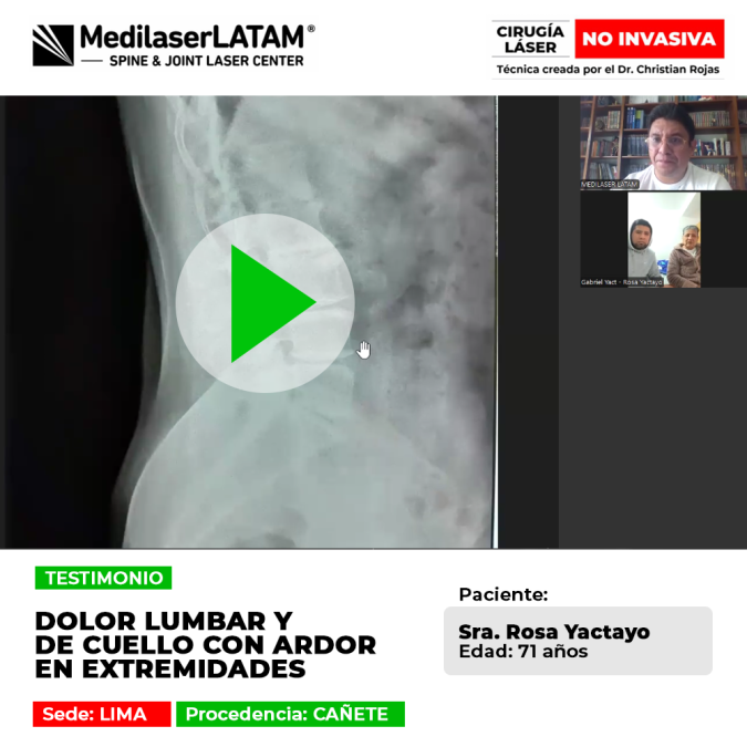 Dolor lumbar y de cuello con ardor en extremidades tratado con éxito mediante tecnología láser avanzada en Medilaser LATAM.