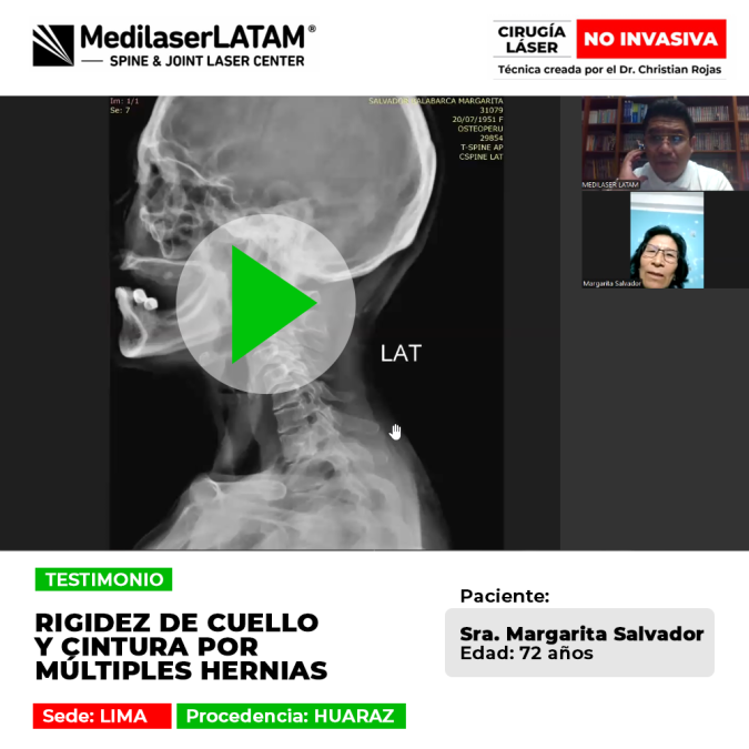 Rigidez de cuello y cintura por múltiples hernias tratada de forma efectiva con tecnología láser en Medilaser LATAM.