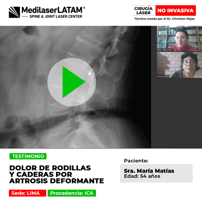 Dolor de rodillas y caderas por Artrosis deformante. Logre una vida sin limitaciones y vuelva a caminar con normalidad en Medilaser LATAM.