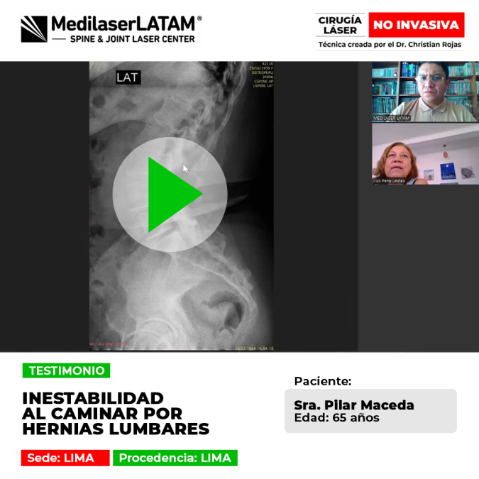 Inestabilidad al caminar por hernias lumbares. Recupere el equilibrio y la fuerza en sus piernas con nuestro tratamiento láser sin cirugía.