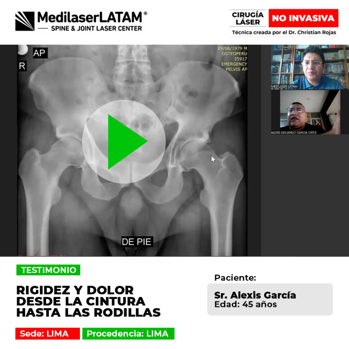 Rigidez y dolor desde la cintura hasta las rodillas tratados con tecnología láser. Recupera tu movilidad con un tratamiento seguro y sin cirugía.