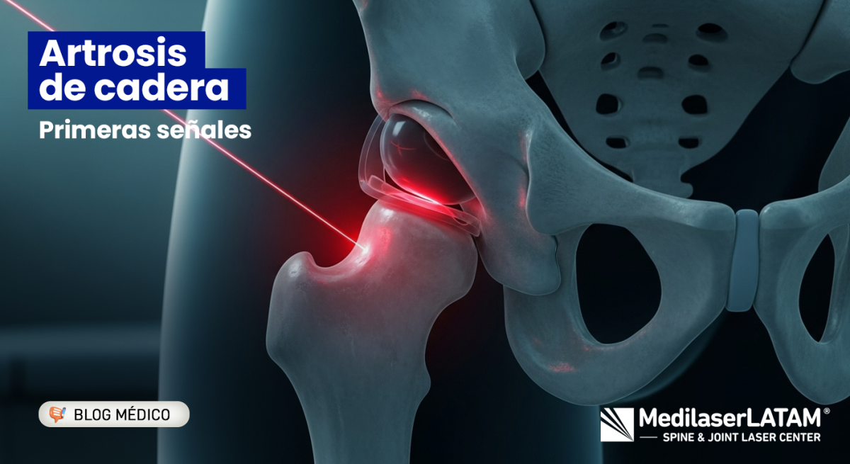 ¿Dolor en la ingle o rigidez al caminar? Conoce los síntomas de artrosis de cadera y cómo frenar el desgaste sin prótesis ni cirugías.