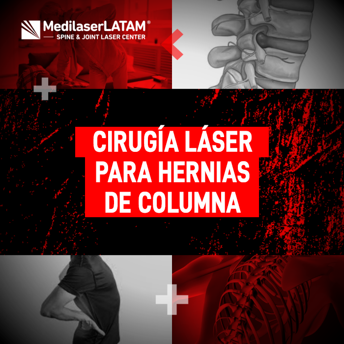 Descubre cómo funciona la cirugía láser para tratar Hernias de columna sin cortes. Información clave sobre tecnología médica avanzada.
