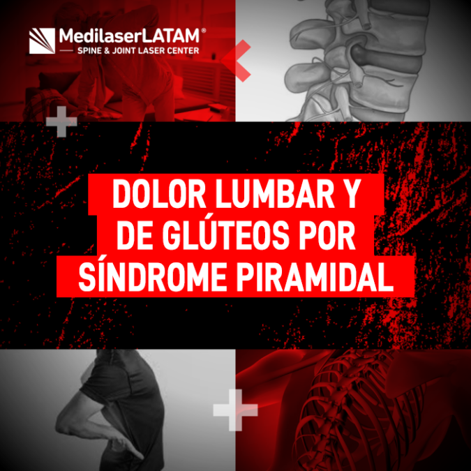 El dolor lumbar y en glúteos suele confundirse con hernias, pero puede ser síndrome piramidal. Aprende a identificarlo y tratarlo correctamente.