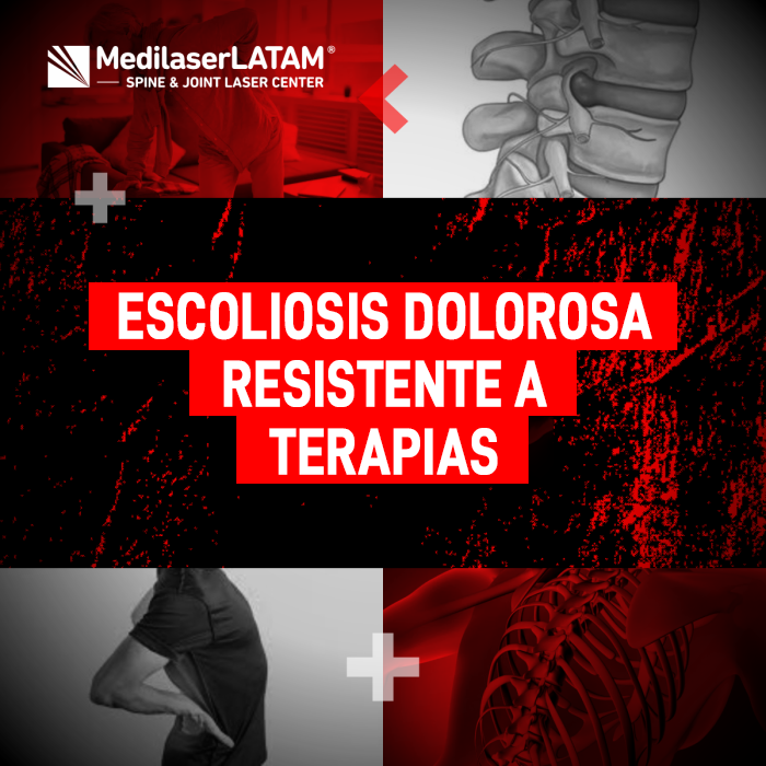 ¿Sufres de Escoliosis dolorosa que no mejora con terapias? Conoce las alternativas de tratamiento láser para aliviar el dolor persistente.