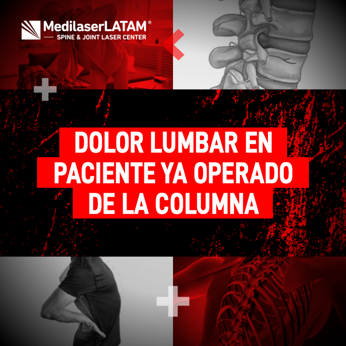 El dolor lumbar persistente después de una cirugía de columna requiere un enfoque especializado. Conoce cómo tratarlo con tecnología láser médica.