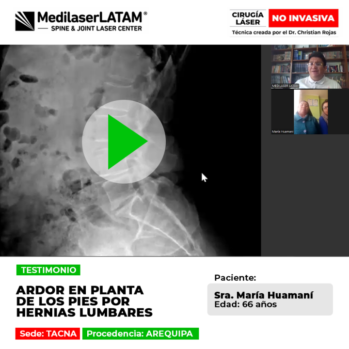 Ardor en planta de los pies causado por hernias lumbares. Recupere su autonomía y elimine la presión nerviosa con tecnología láser.
