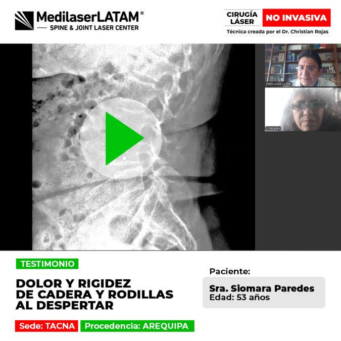 Paciente recupera la movilidad de cadera y rodillas tras tratamiento láser. Conoce cómo superó la rigidez articular sin cirugías invasivas.
