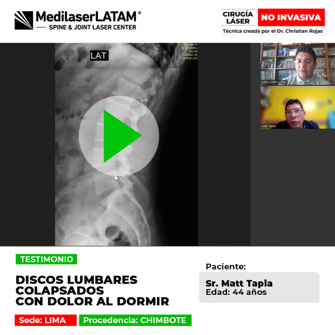 Testimonio sobre el tratamiento de discos lumbares colapsados y dolor nocturno. Recupera el descanso con procedimientos láser mínimamente invasivos.