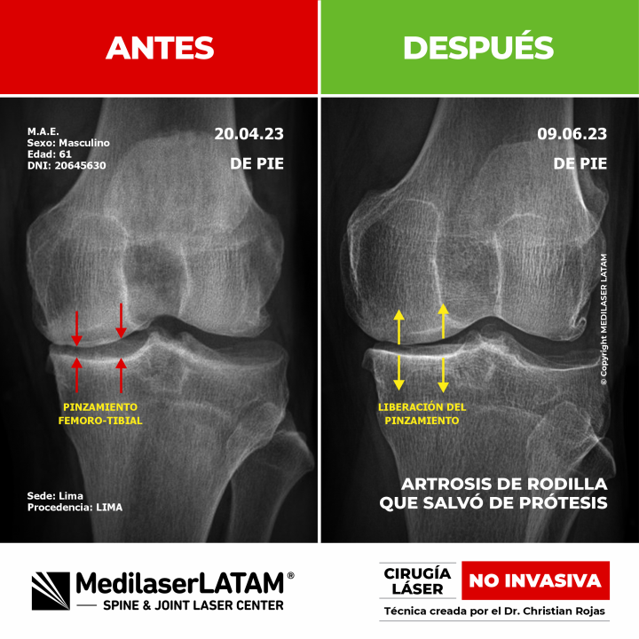 Artrosis de rodilla: evidencia científica de cómo el láser detiene el desgaste articular y elimina el dolor, evitando la prótesis.