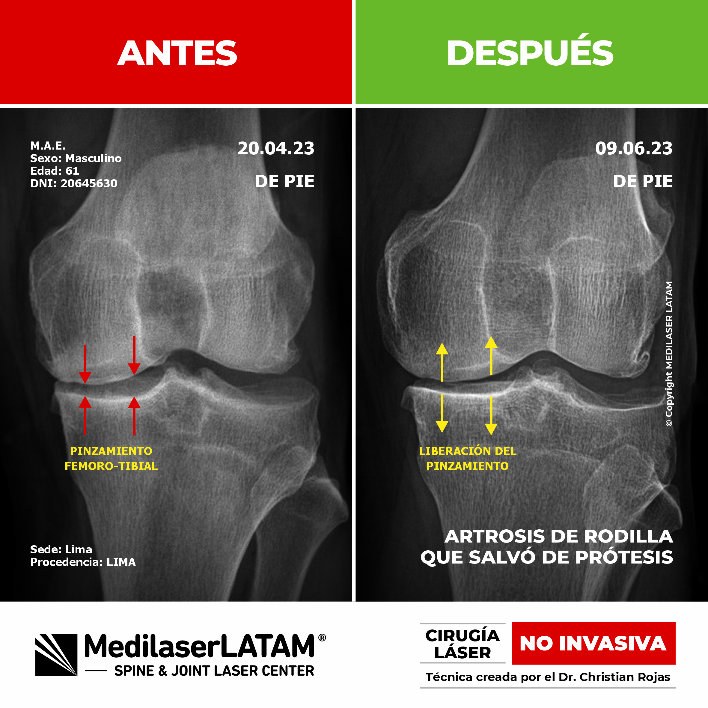 Artrosis de rodilla: evidencia científica de cómo el láser detiene el desgaste articular y elimina el dolor, evitando la prótesis.