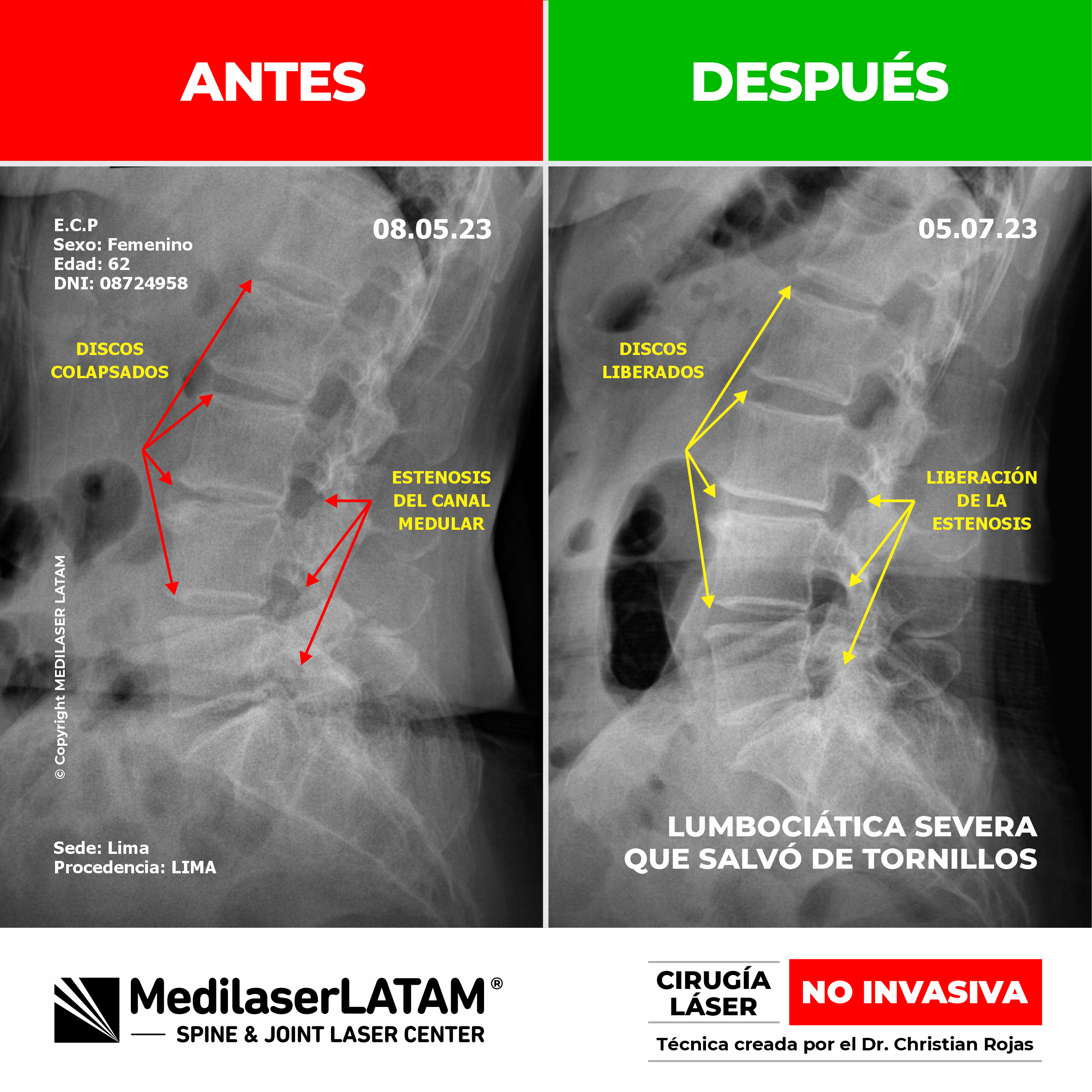 Lumbociática severa: evidencia de descompresión radicular con láser de alta potencia, evitando fijaciones metálicas y cirugía abierta.