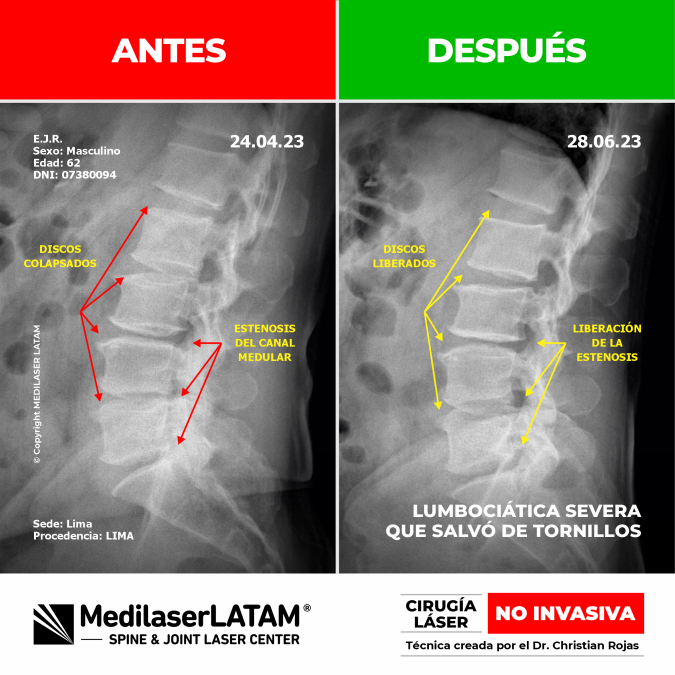 Tratamiento para lumbociática: evidencia científica de la eliminación de la compresión nerviosa sin uso de tornillos ni hospitalización.