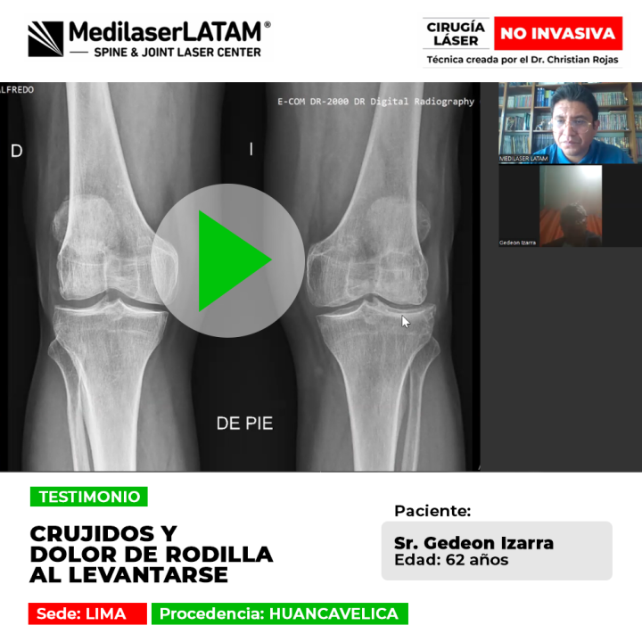 Crujidos y dolor de rodilla al levantarse: paciente de Huancavelica supera la Artrosis y el desgaste articular con tratamiento láser.