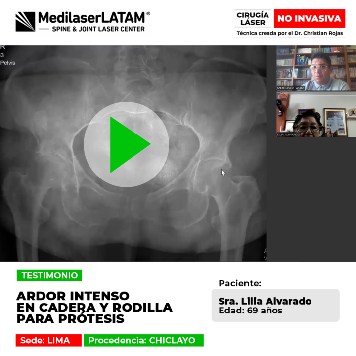 Ardor intenso en cadera y rodilla: paciente de Chiclayo evita la prótesis mediante tecnología láser que regenera y elimina el dolor crónico.