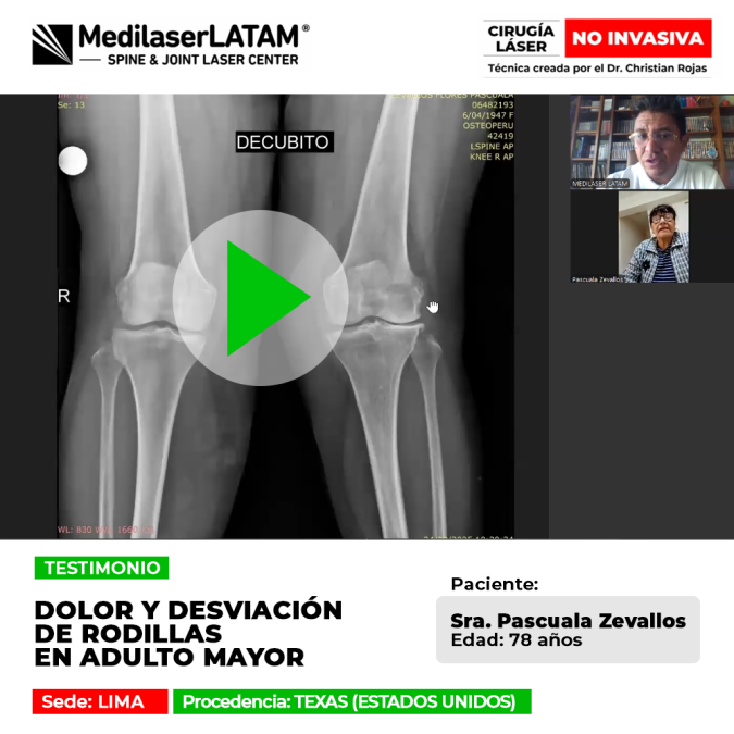 La artrosis causa deformidad. Conoce esta alternativa para corregir el dolor articular sin prótesis invasivas.