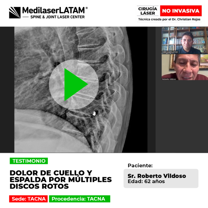 ¿Discos rotos en la columna? Descubre un procedimiento de vanguardia para regenerar tu espalda y eliminar molestias crónicas.