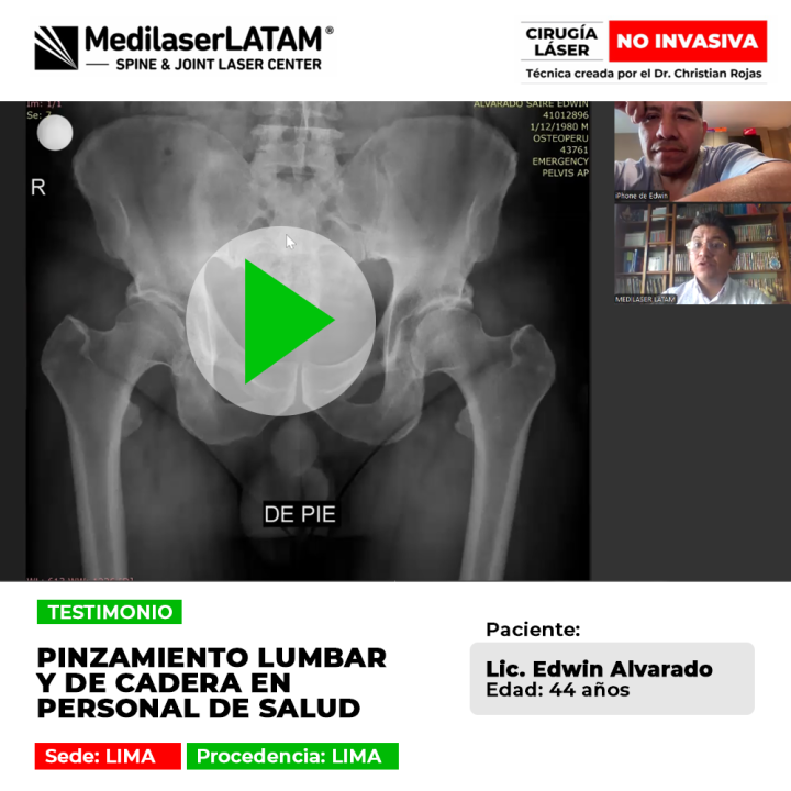 El pinzamiento lumbar y de cadera afecta gravemente el desempeño del personal de salud. Descubre la tecnología médica que permite una recuperación rápida y sin cortes.
