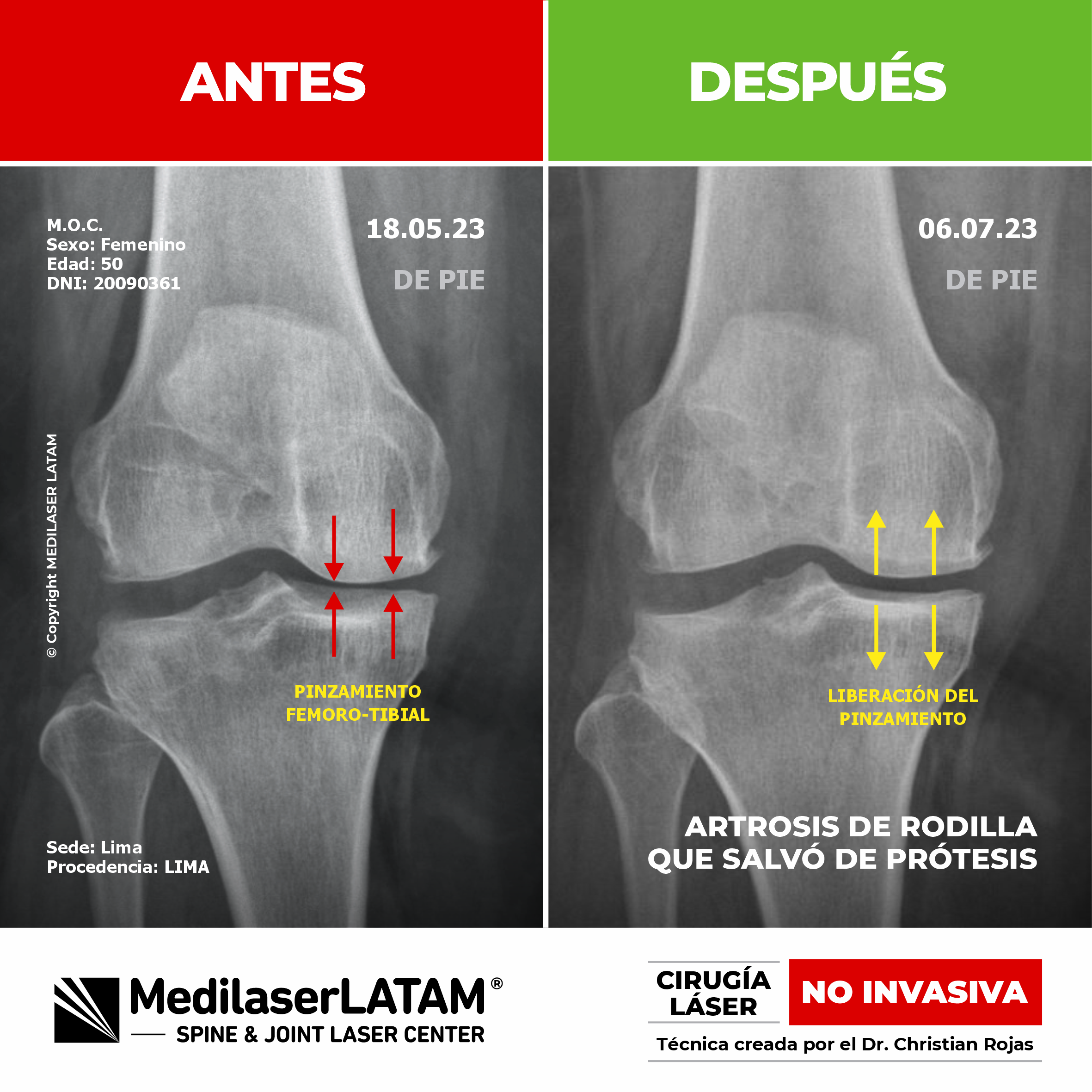 Evidencia científica de artrosis de rodilla avanzada que logró evitar la prótesis gracias al tratamiento de Cirugía Láser NO INVASIVA.