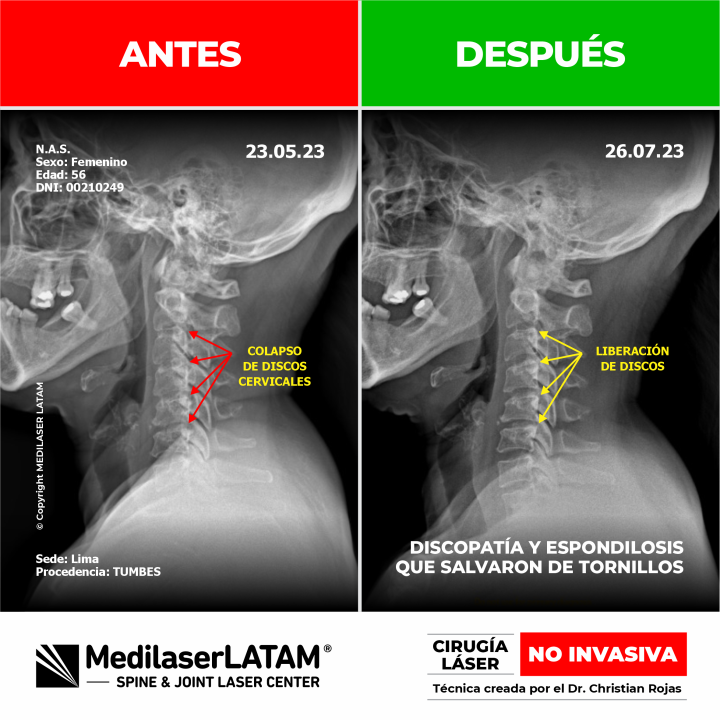 Evidencia científica de la regresión en artrosis cervical. Resultados clínicos comprobados con el tratamiento de Cirugía Láser NO INVASIVA.