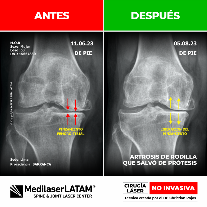 Estudio radiológico que demuestra la regresión en gonartrosis. Recuperación de la articulación de la rodilla con Cirugía Láser NO INVASIVA.