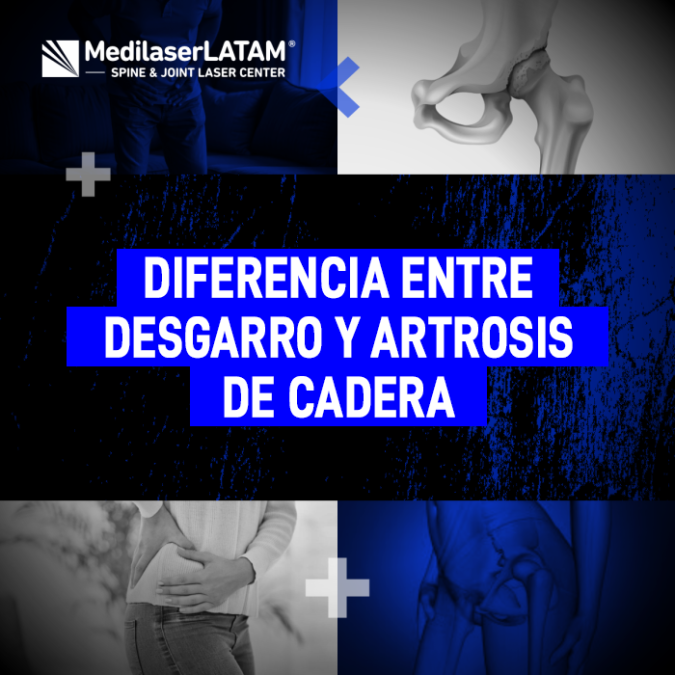 La artrosis de cadera y un desgarro muscular comparten síntomas pero requieren manejos distintos. Conoce cómo diferenciarlos médicamente.