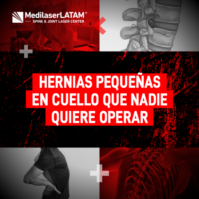 Las hernias pequeñas en cuello también producen un dolor severo e invalidante. Entiende por qué ocurren y cómo tratarlas eficazmente.