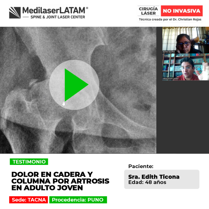 Artrosis en cadera y columna en adultos jóvenes: conoce sus síntomas principales y los tratamientos médicos indicados.