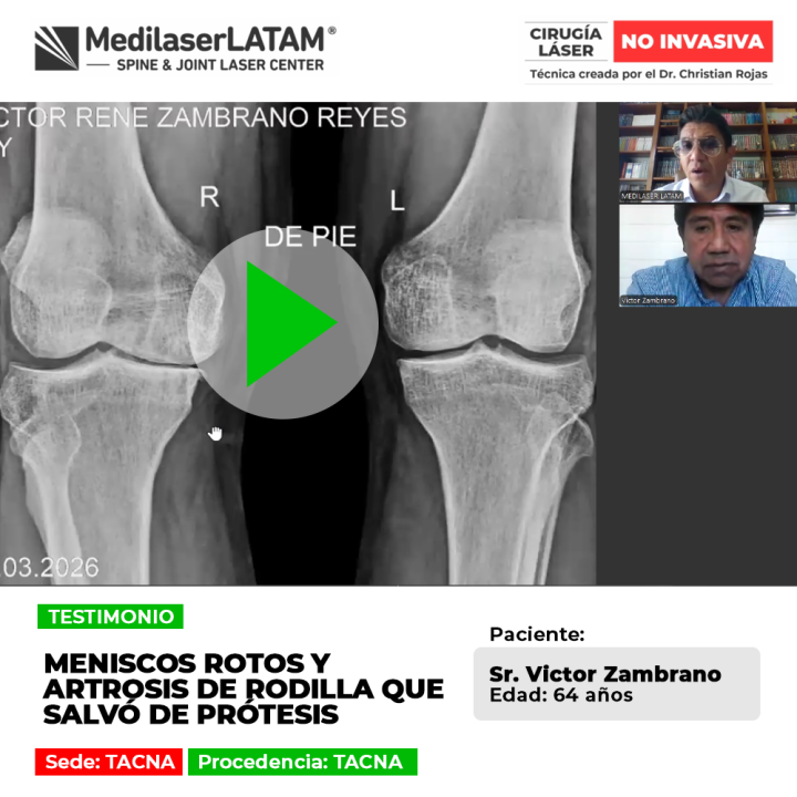 Los meniscos rotos junto al desgaste articular pueden tratarse sin prótesis. Infórmate sobre procedimientos médicos especializados.