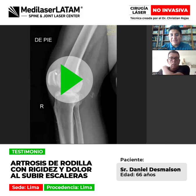 La artrosis de rodilla causa rigidez severa y dificulta subir escaleras a diario. Conoce tratamientos oportunos para recuperar fuerza.