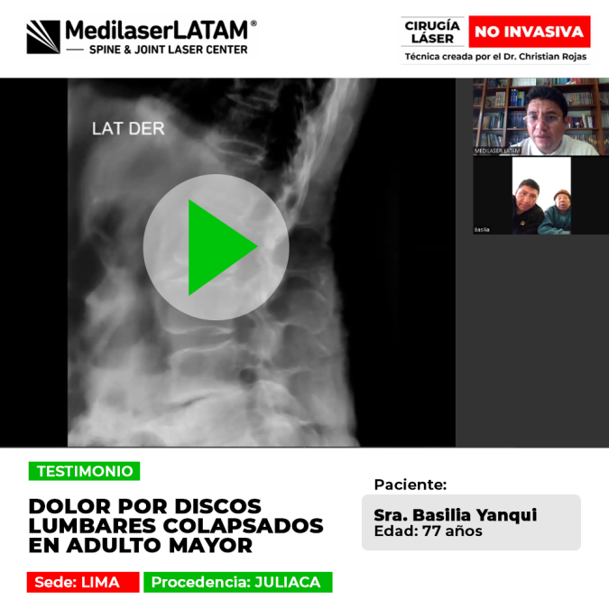 Los discos lumbares colapsados en adultos mayores causan dolores intensos. Descubre opciones médicas para volver a caminar con alivio.