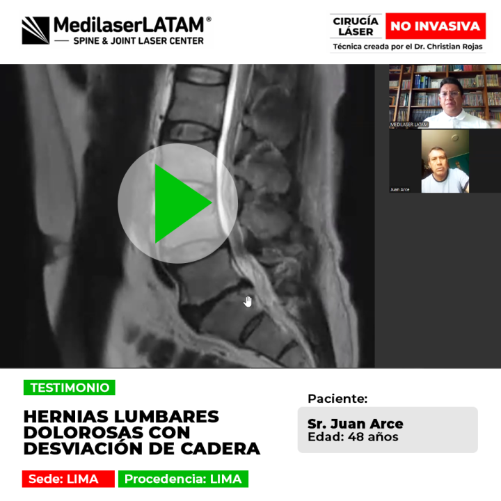 Las hernias lumbares dolorosas pueden provocar desviaciones en la cadera. Infórmate sobre alternativas médicas para recuperar postura.